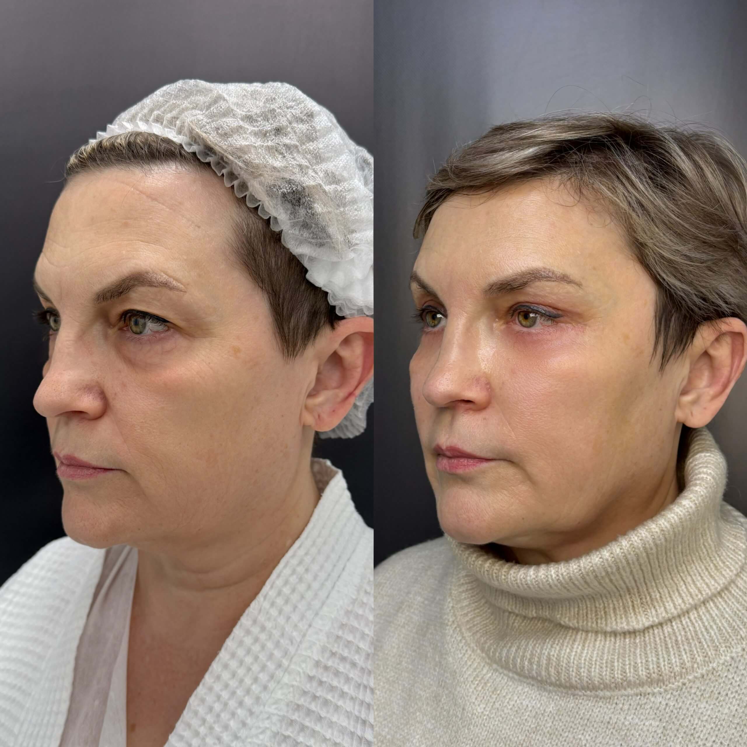 Нижняя блефаропластика 01