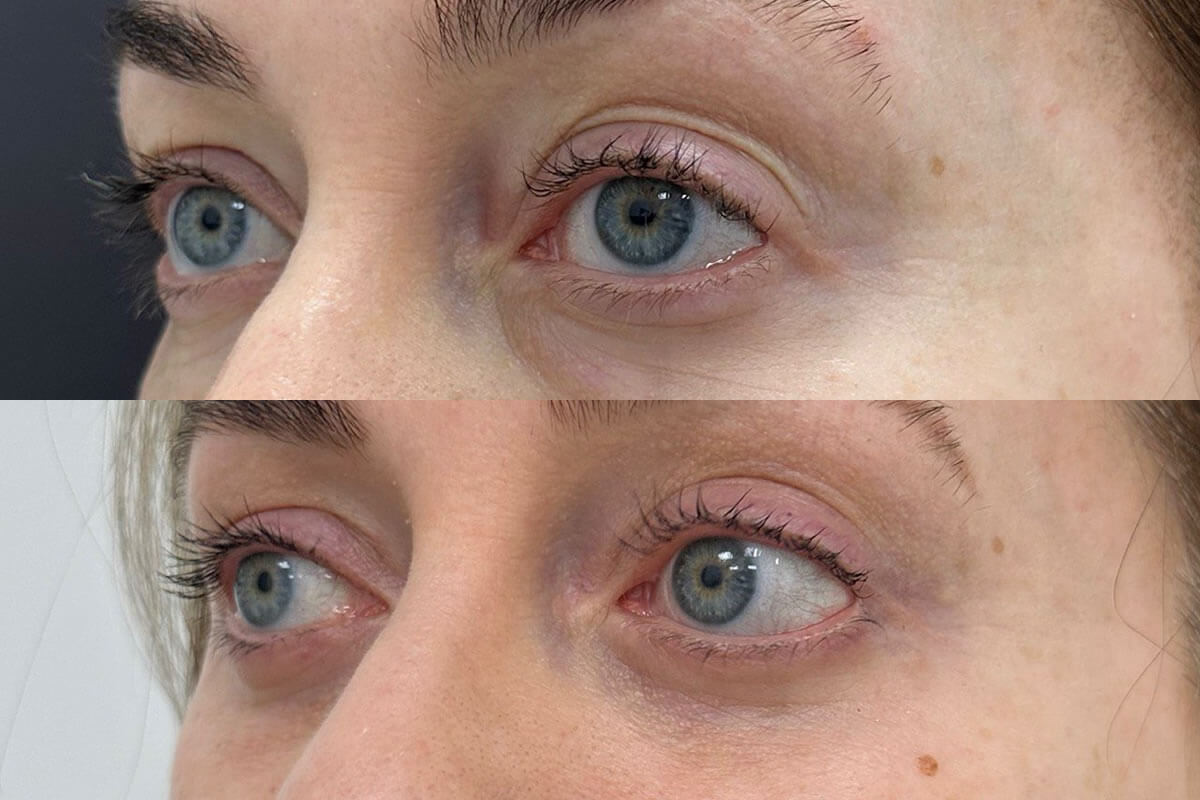 Нижняя блефаропластика 01