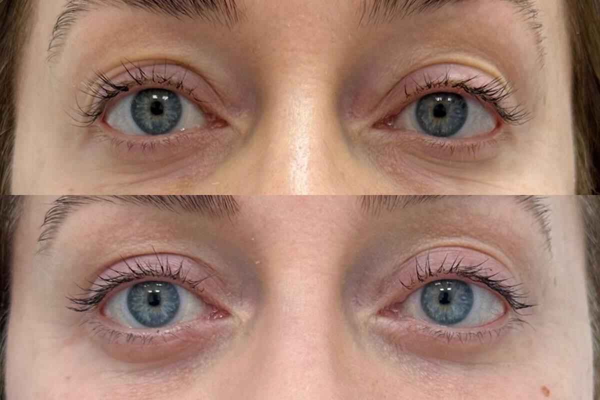 Нижняя блефаропластика 01