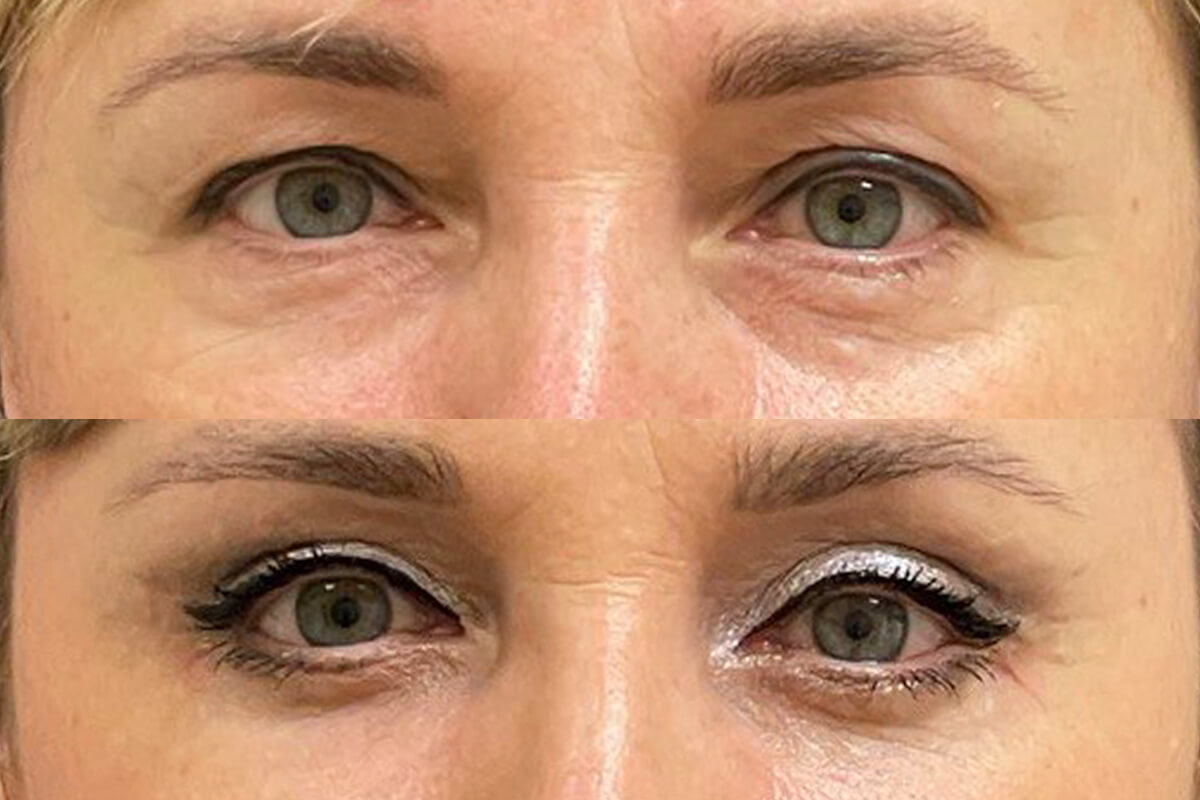 Нижняя блефаропластика 01