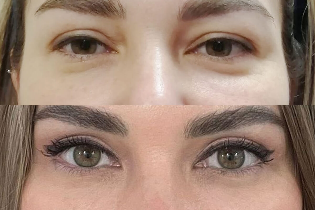 Нижняя блефаропластика 01