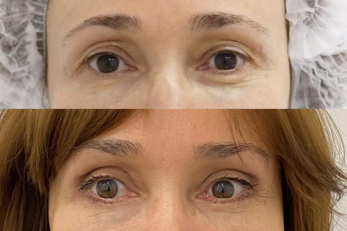 Нижняя блефаропластика 01