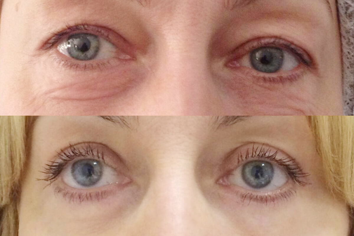 Нижняя блефаропластика 01