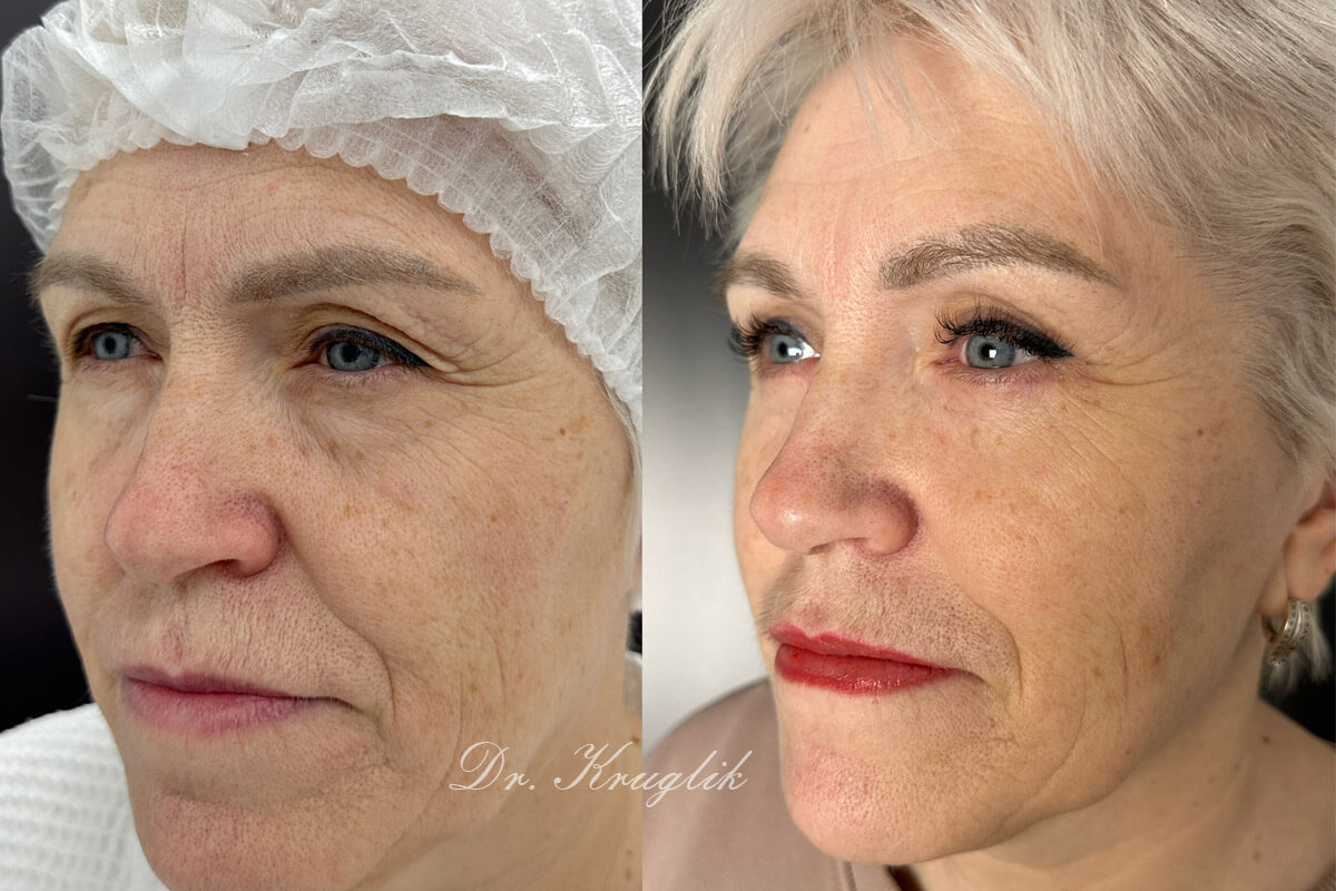 Нижняя блефаропластика 01