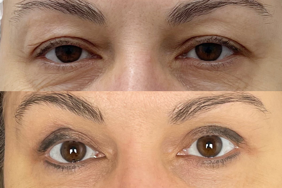 Нижняя блефаропластика 01