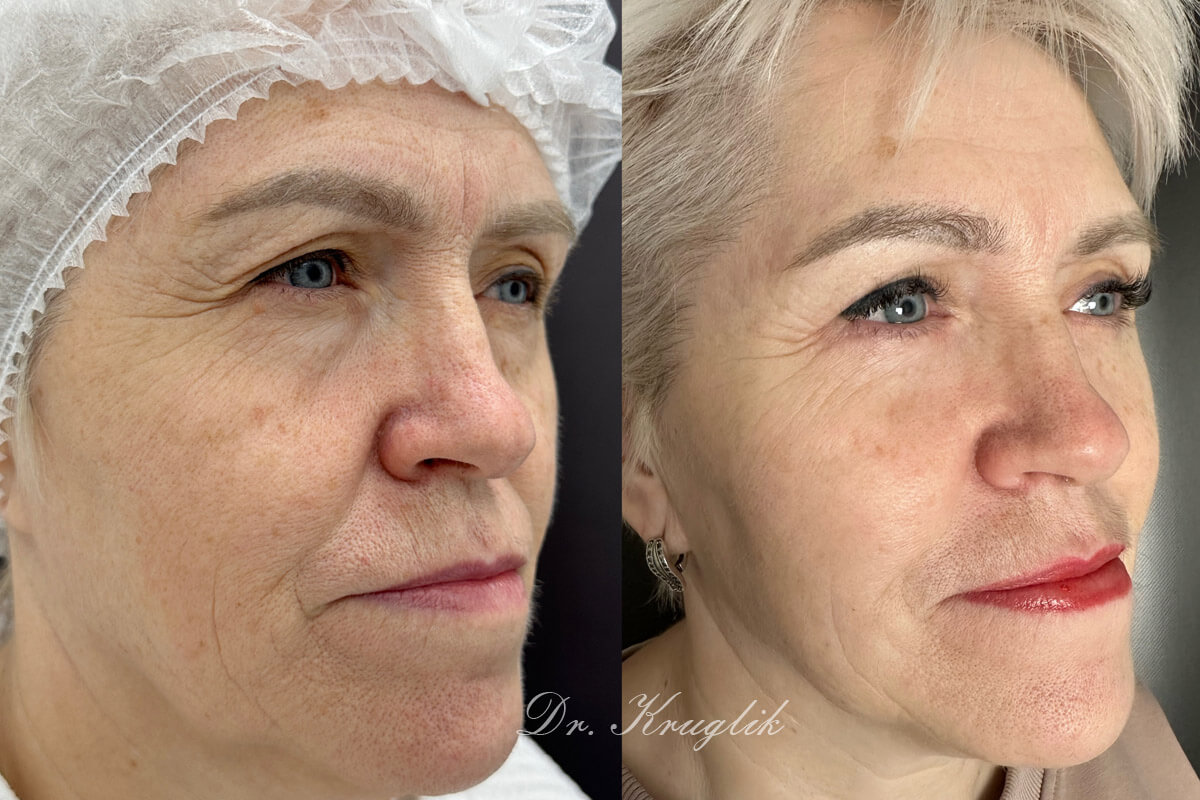 Нижняя блефаропластика 01