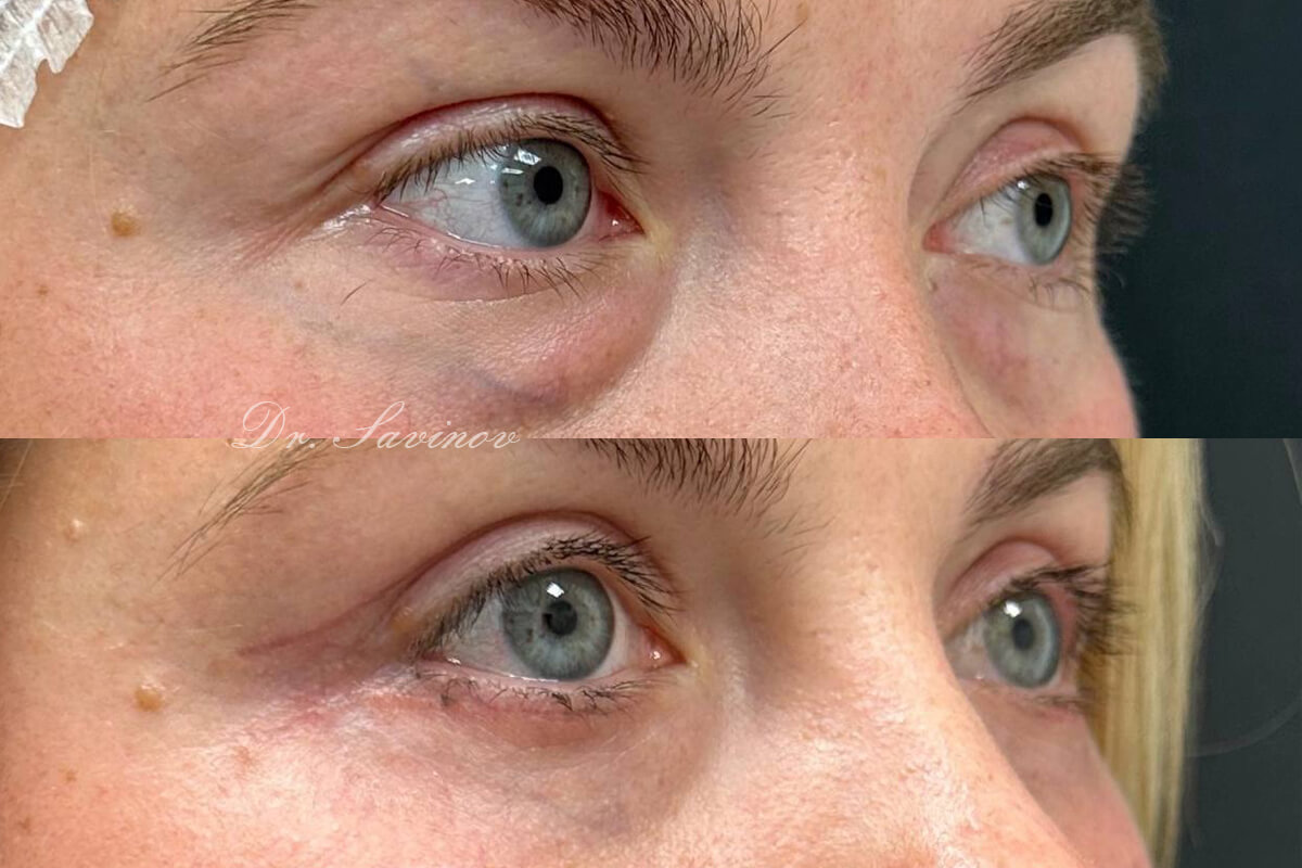 Нижняя блефаропластика 01