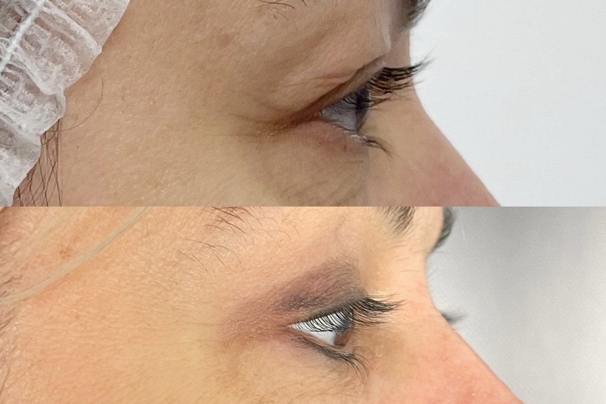 Нижняя блефаропластика 01