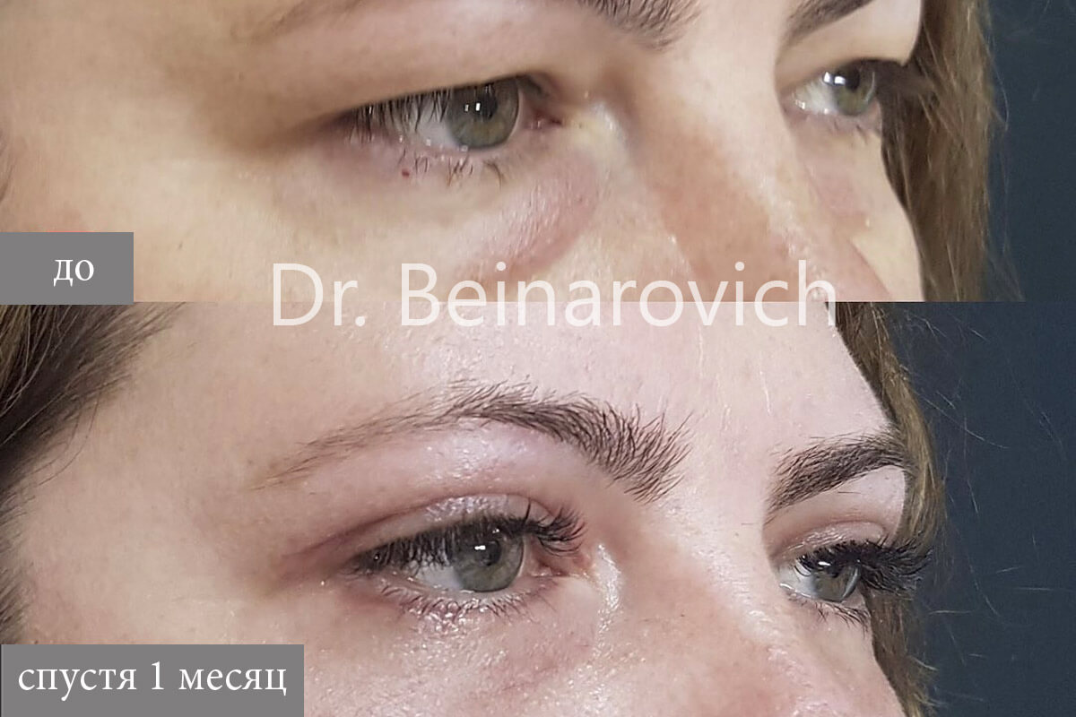 Нижняя блефаропластика 01