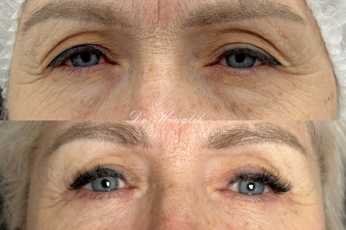 Нижняя блефаропластика 01