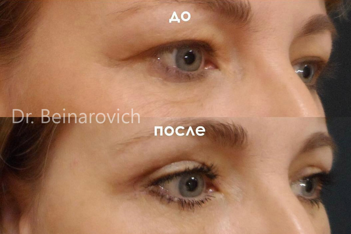 Нижняя блефаропластика 01