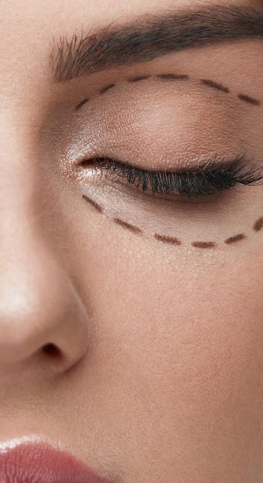 Круговая блефаропластика