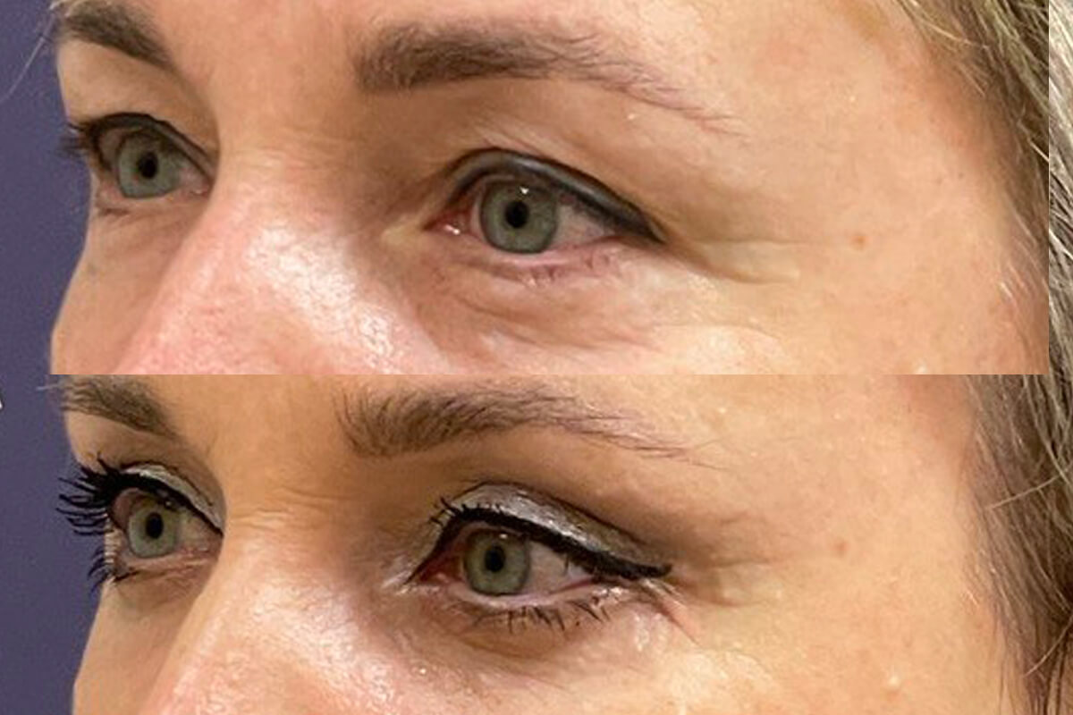 Нижняя блефаропластика 01