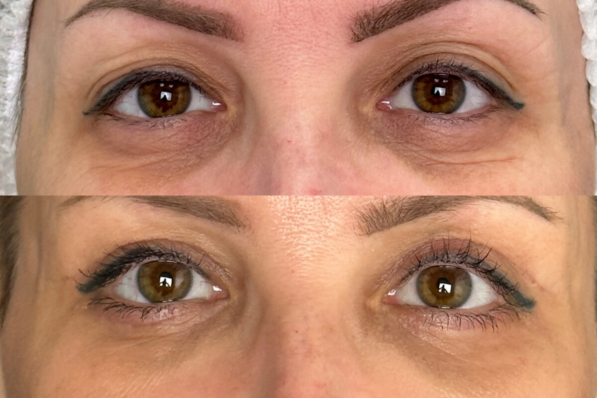 Нижняя блефаропластика 01