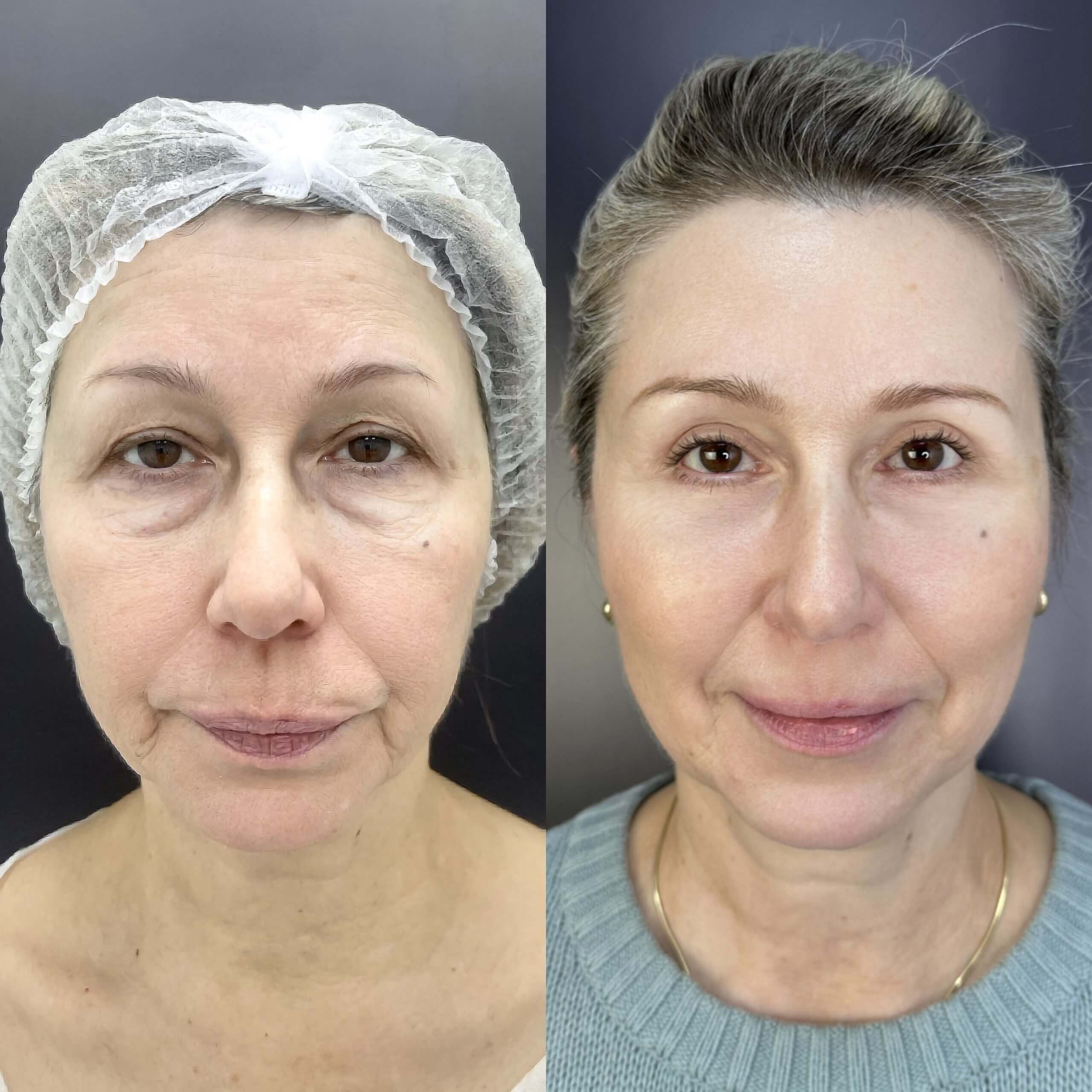 Нижняя блефаропластика 01