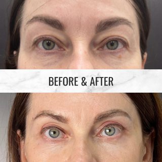 Нижняя блефаропластика 01