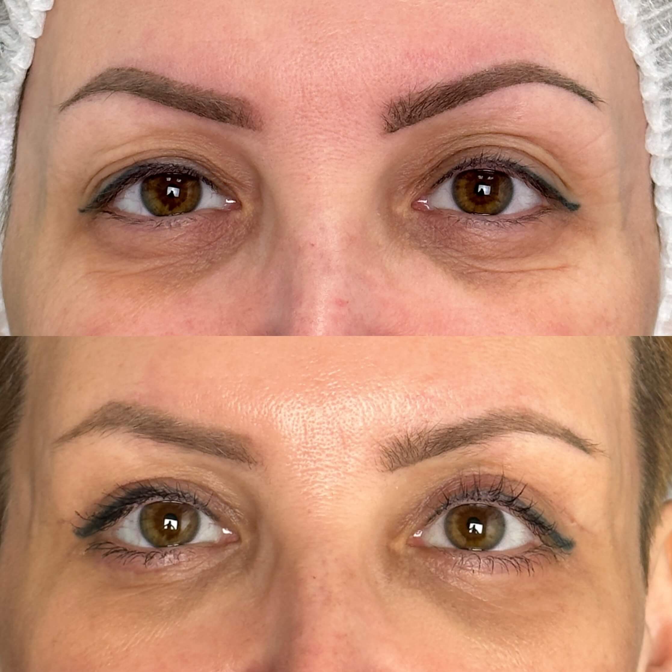 Нижняя блефаропластика 01