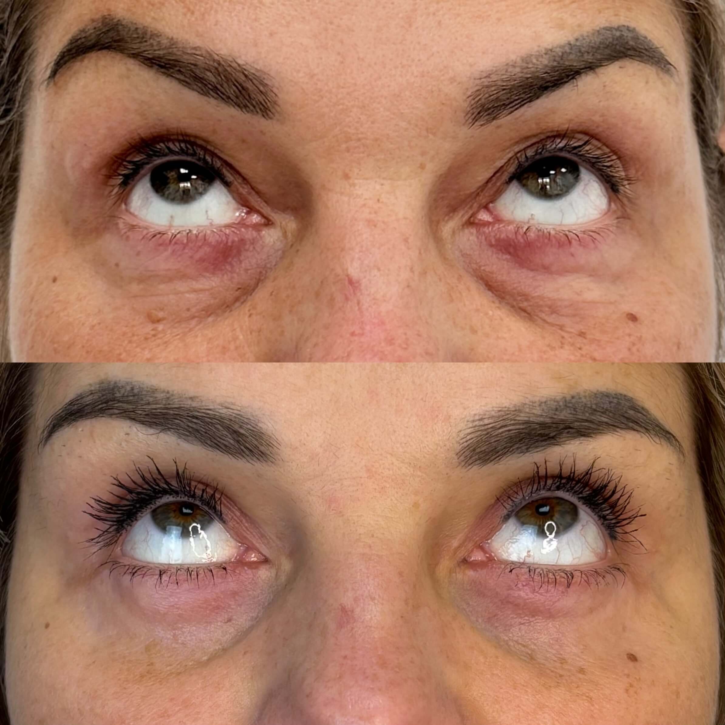 Нижняя блефаропластика 01