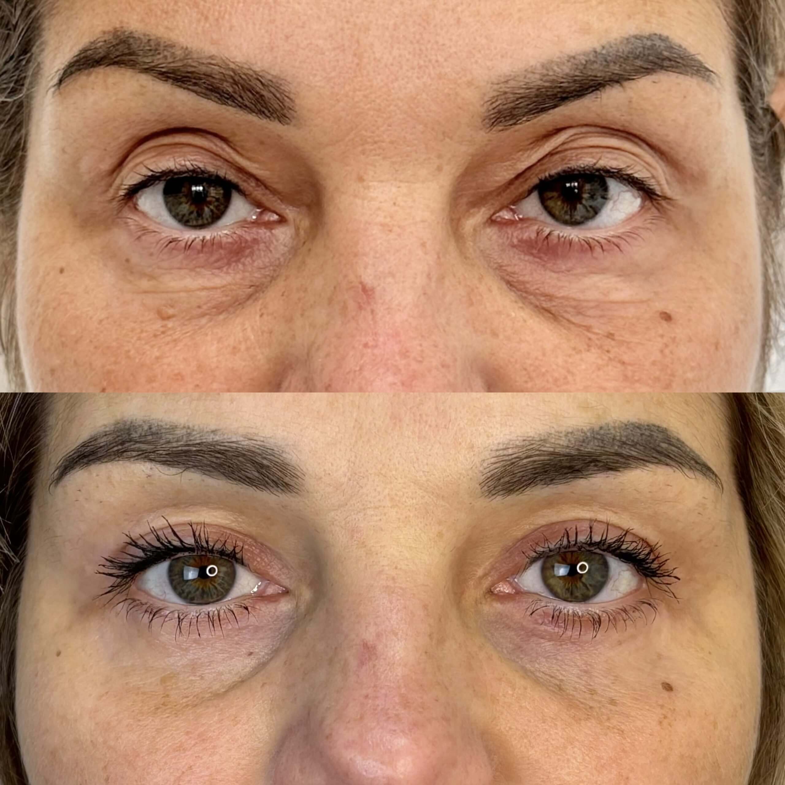 Нижняя блефаропластика 01