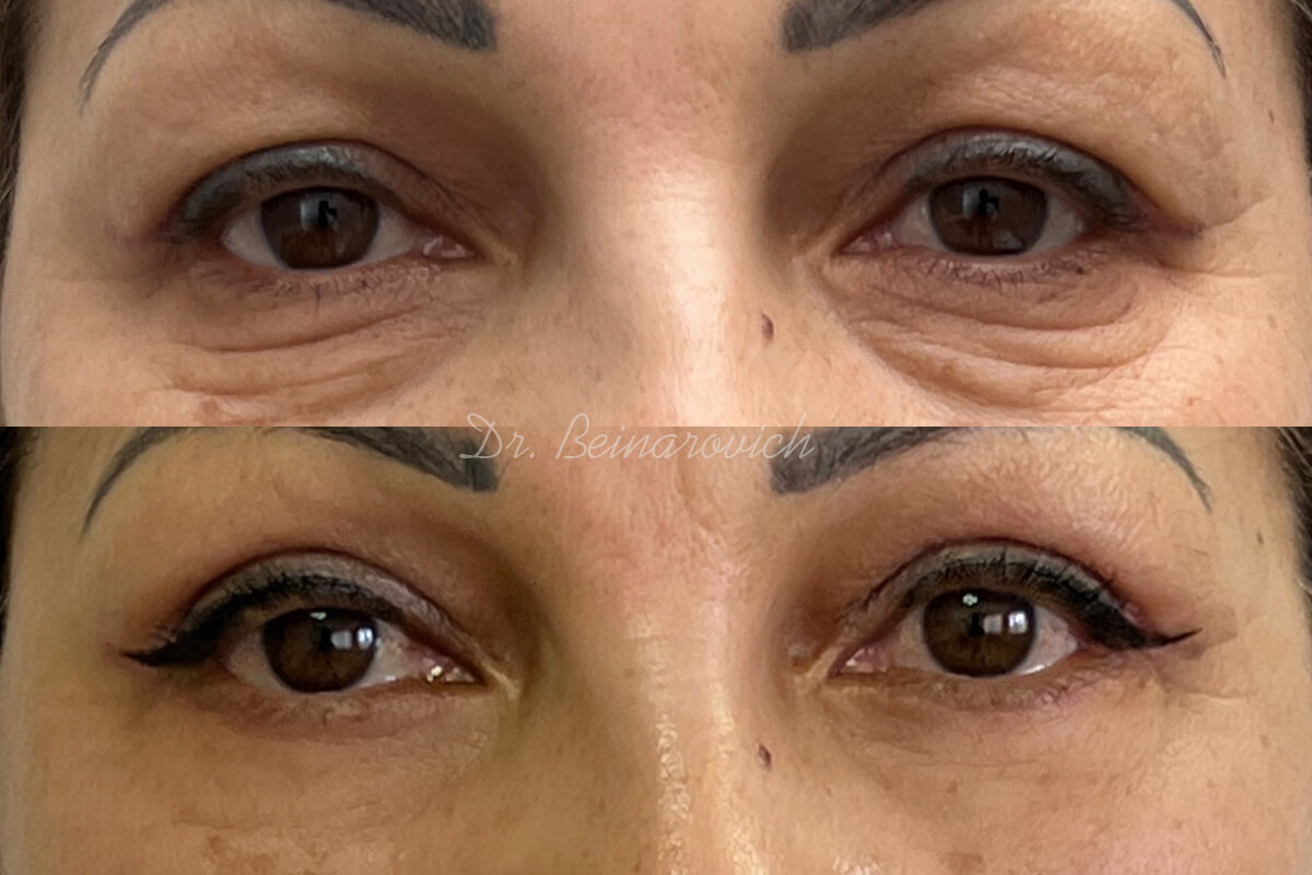 Нижняя блефаропластика 01