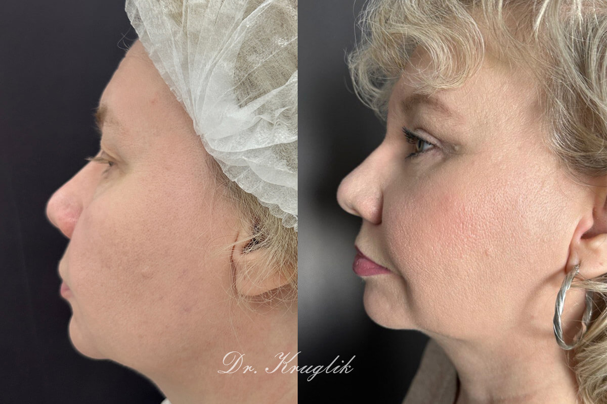 Нижняя блефаропластика 01