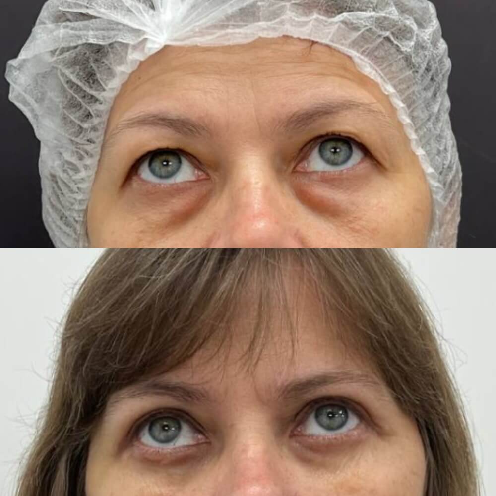 Нижняя блефаропластика 01