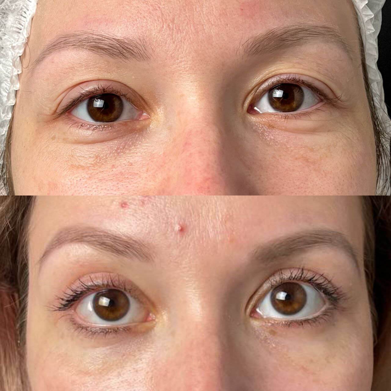 Нижняя блефаропластика 01