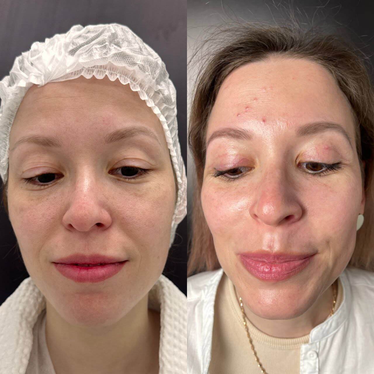 Нижняя блефаропластика 01