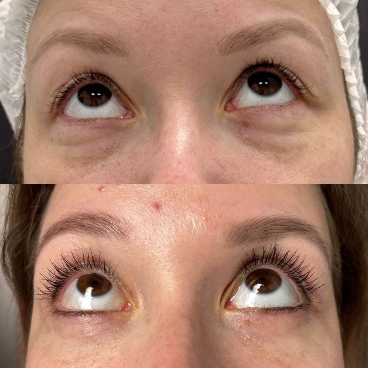 Нижняя блефаропластика 01