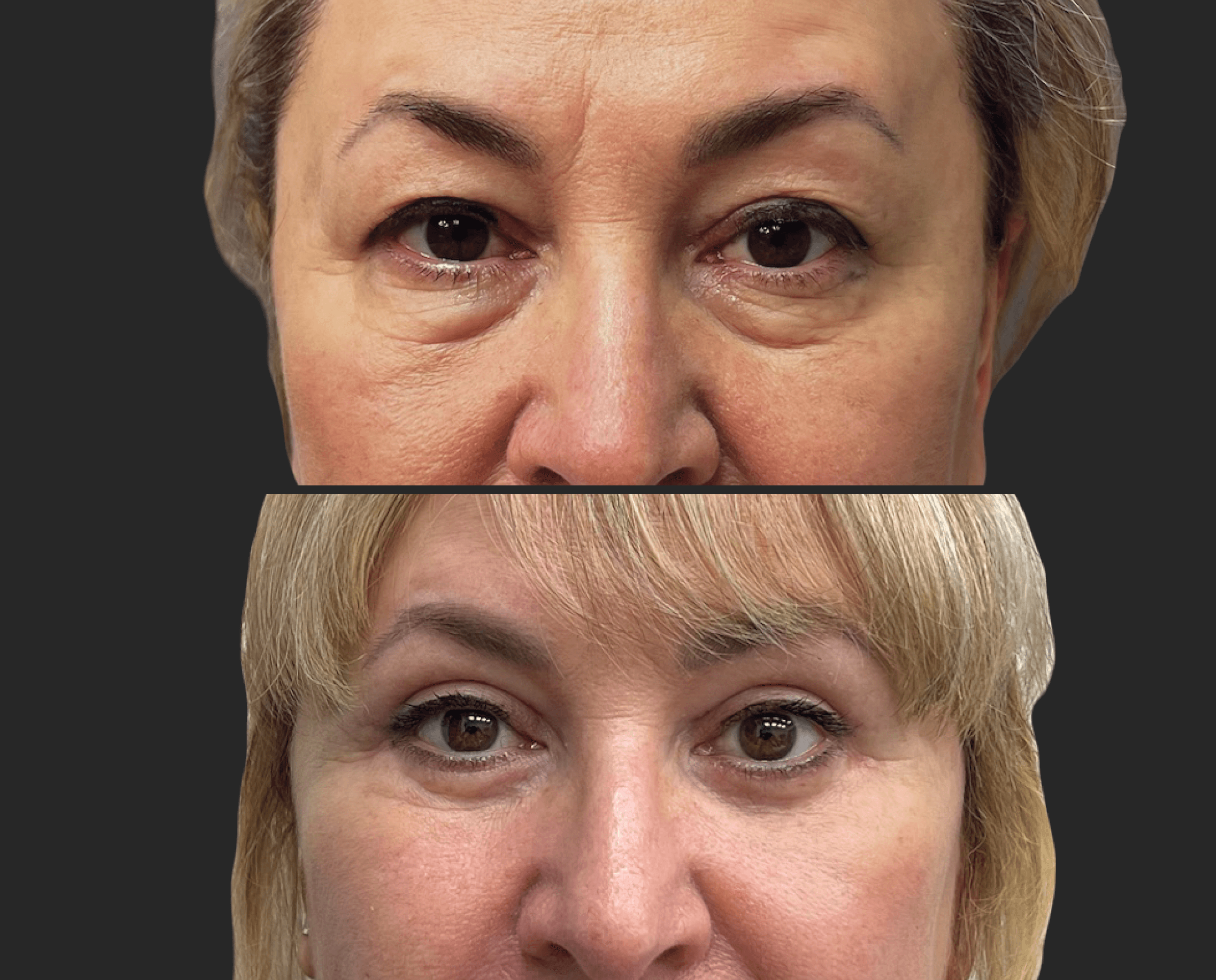 Нижняя блефаропластика 01