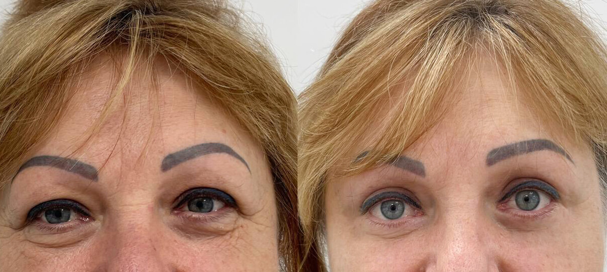 Нижняя блефаропластика 01