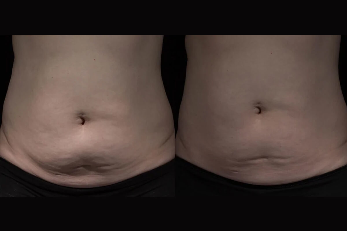 Микроигольчатый лифтинг POTENZA 01