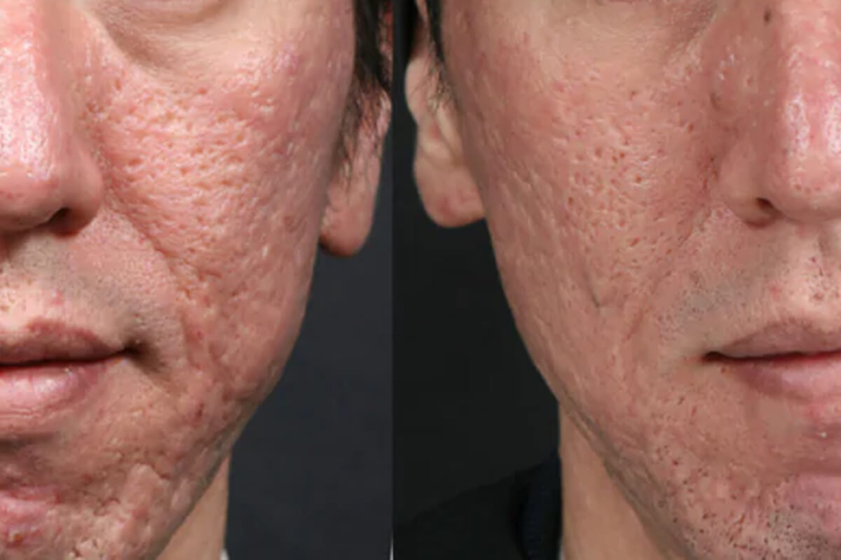 Микроигольчатый лифтинг POTENZA 01