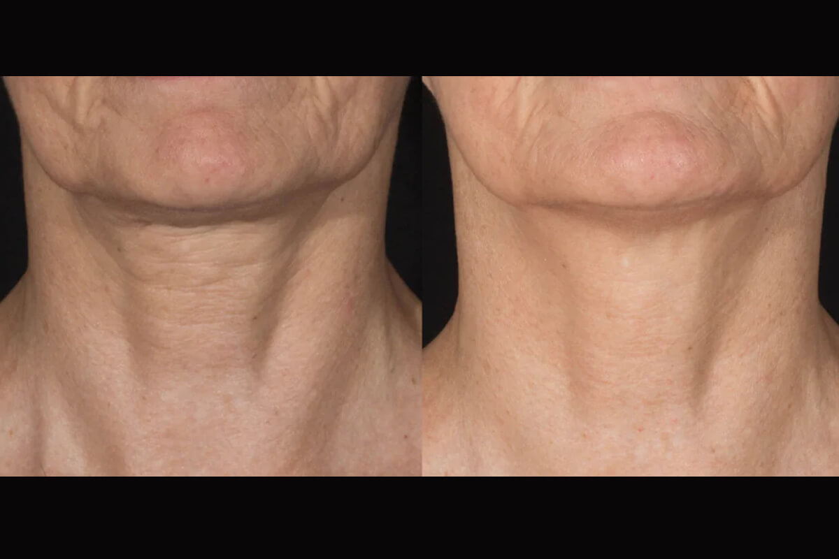 Микроигольчатый лифтинг POTENZA 01