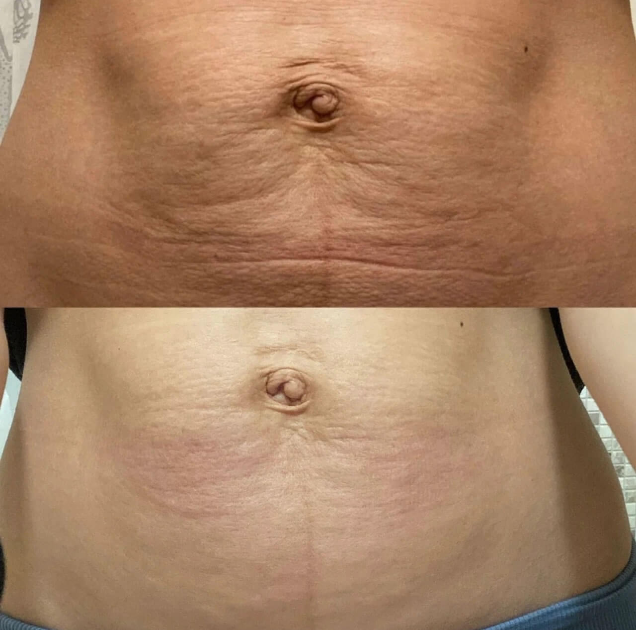 Микроигольчатый RF-лифтинг Morpheus 8 01