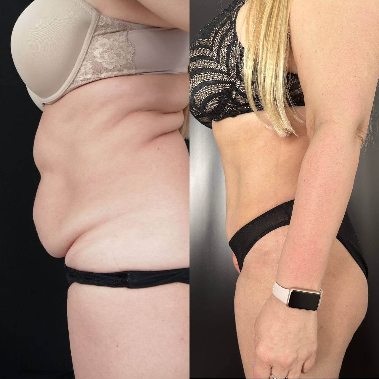 Абдоминопластика с липосакцией 01