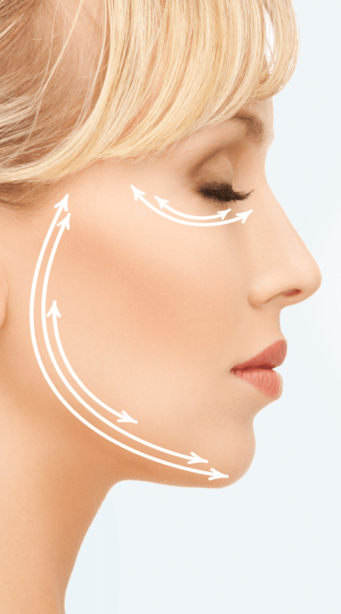 Нитевой лифтинг при поражении лицевого нерва