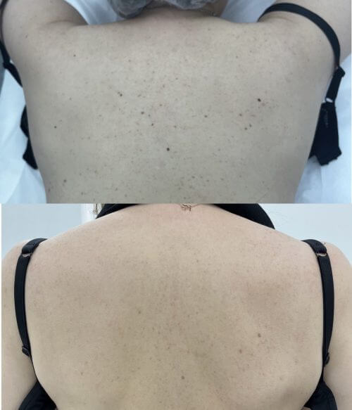 Удаление пигментации PicoSure 01