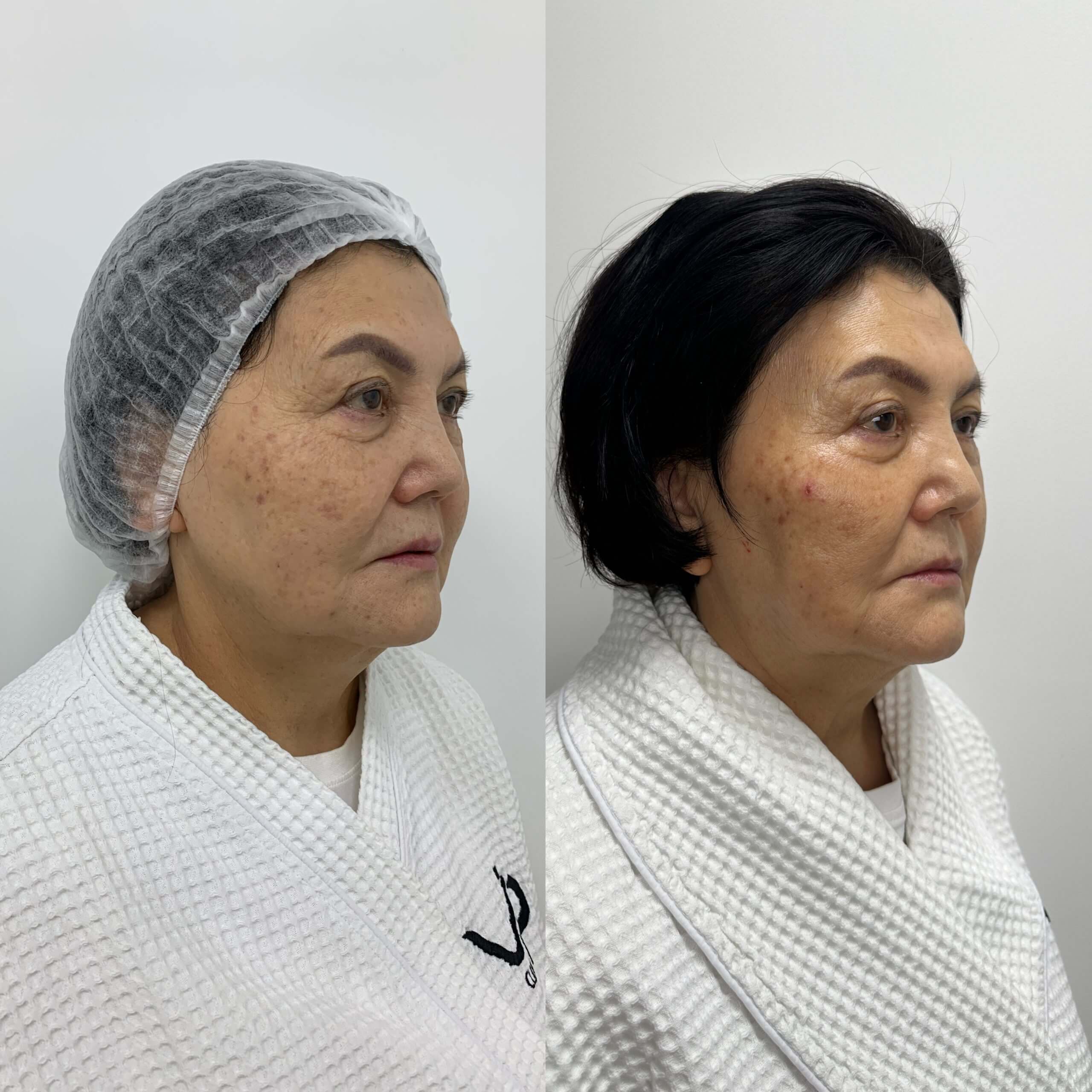 Ультраформер MPT 01