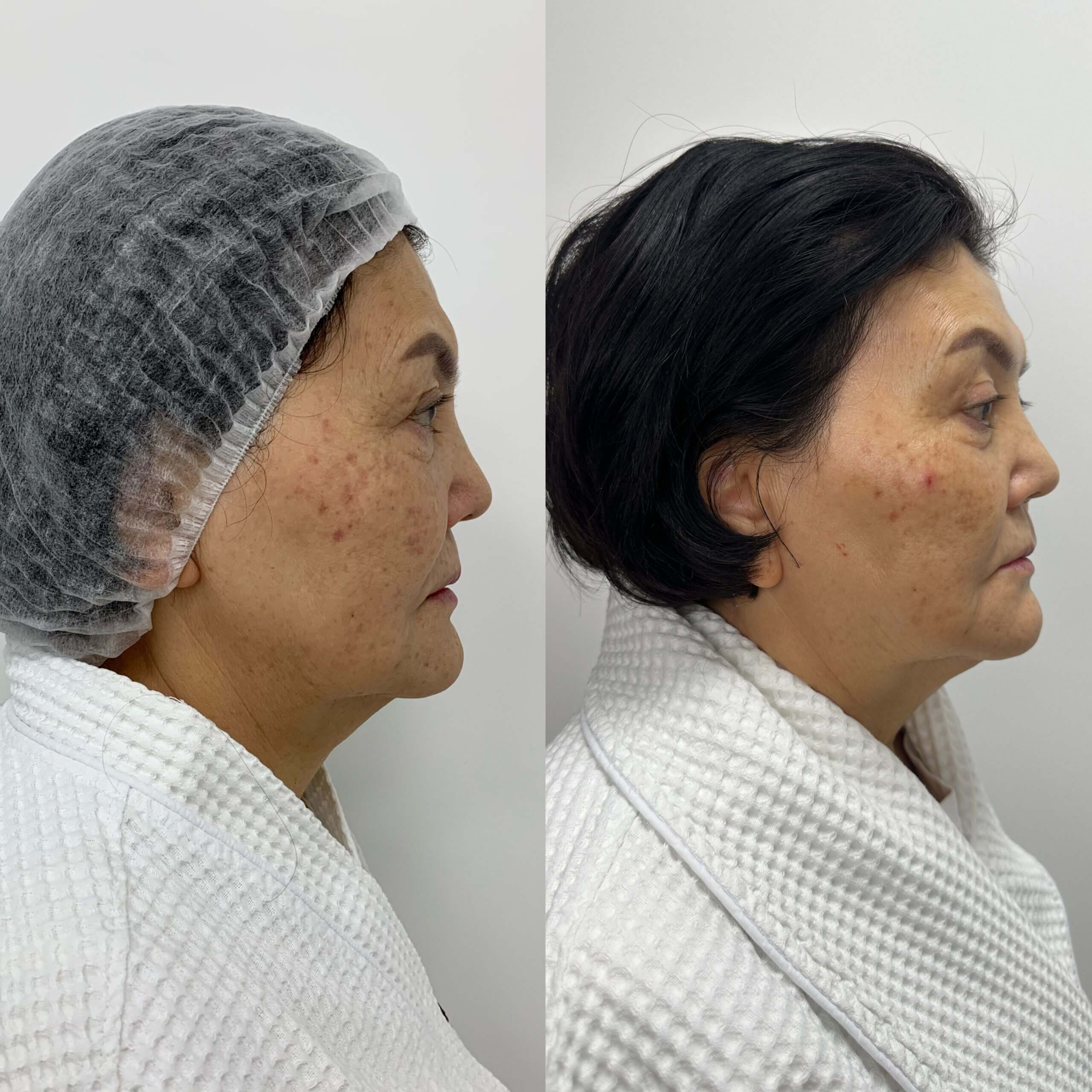 Ультраформер MPT 01