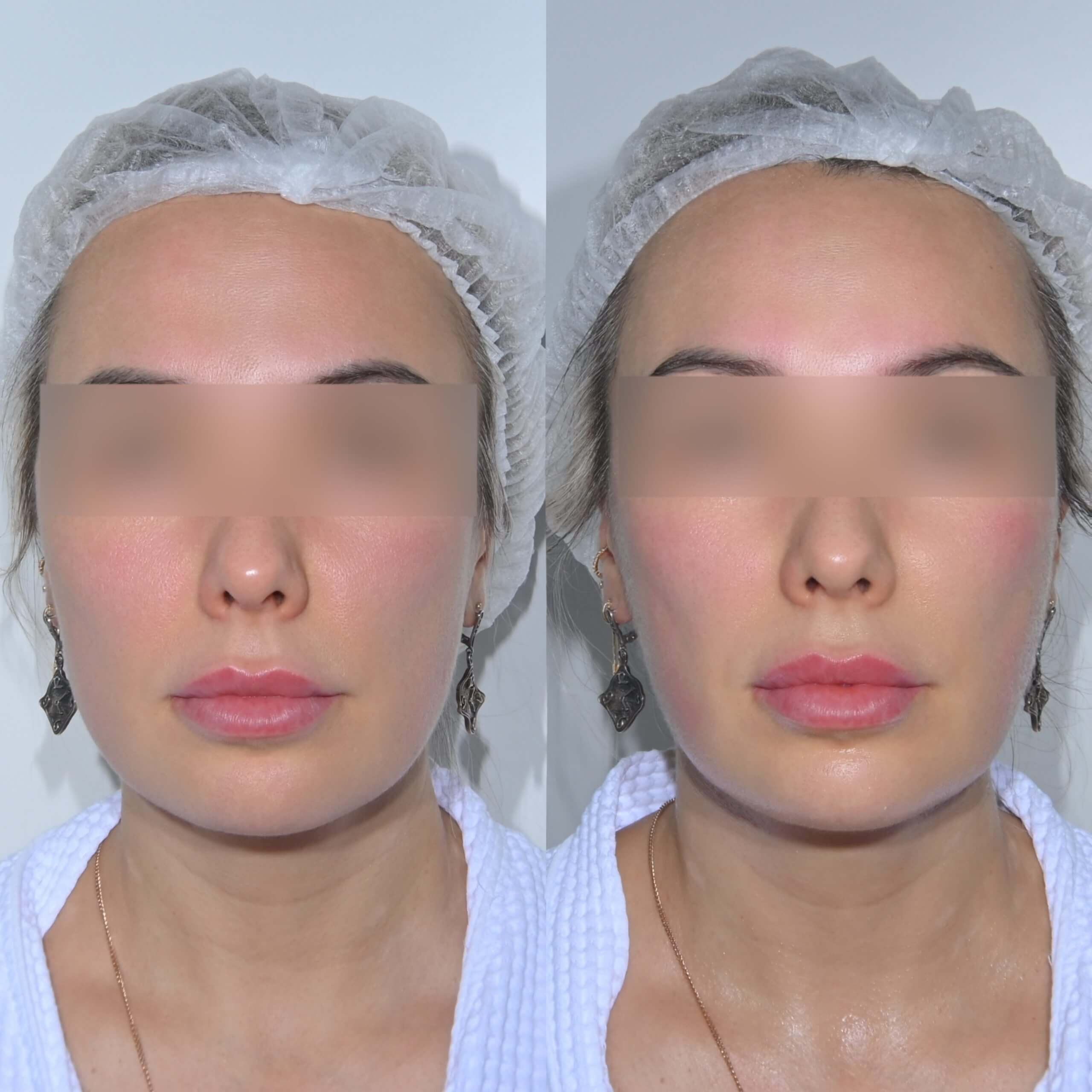 Ультраформер MPT 01