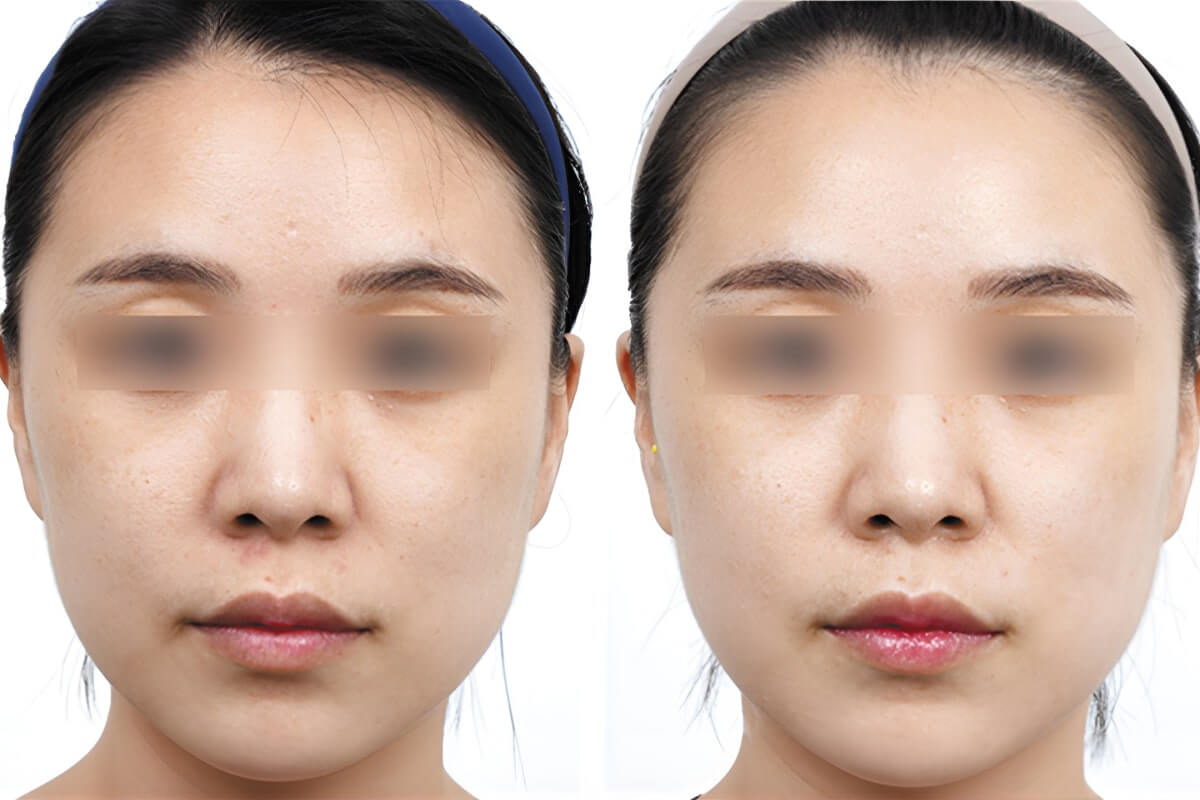 Ультраформер MPT 01