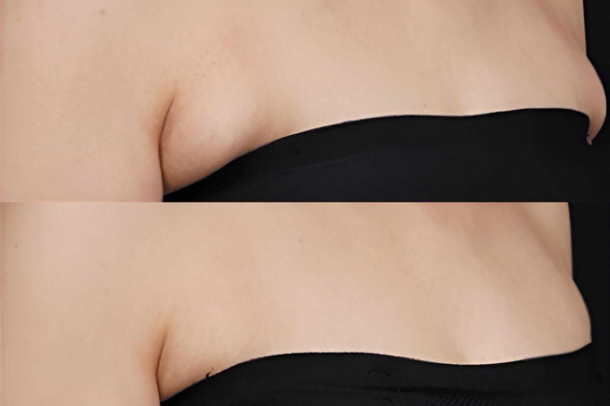 Ультраформер MPT 01