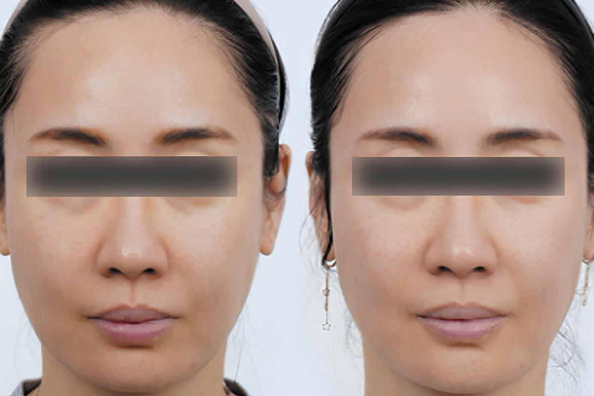 Ультраформер MPT 01