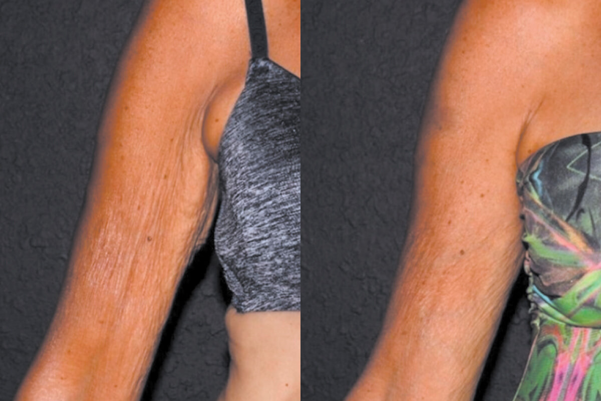 Микроигольчатый RF на аппарате Virtue RF 01