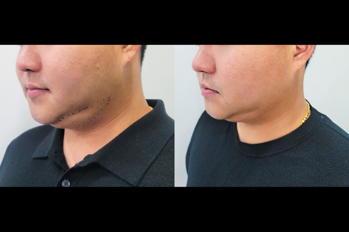 Микроигольчатый RF на аппарате Virtue RF 01