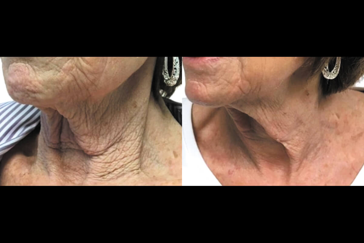 Микроигольчатый RF на аппарате Virtue RF 01