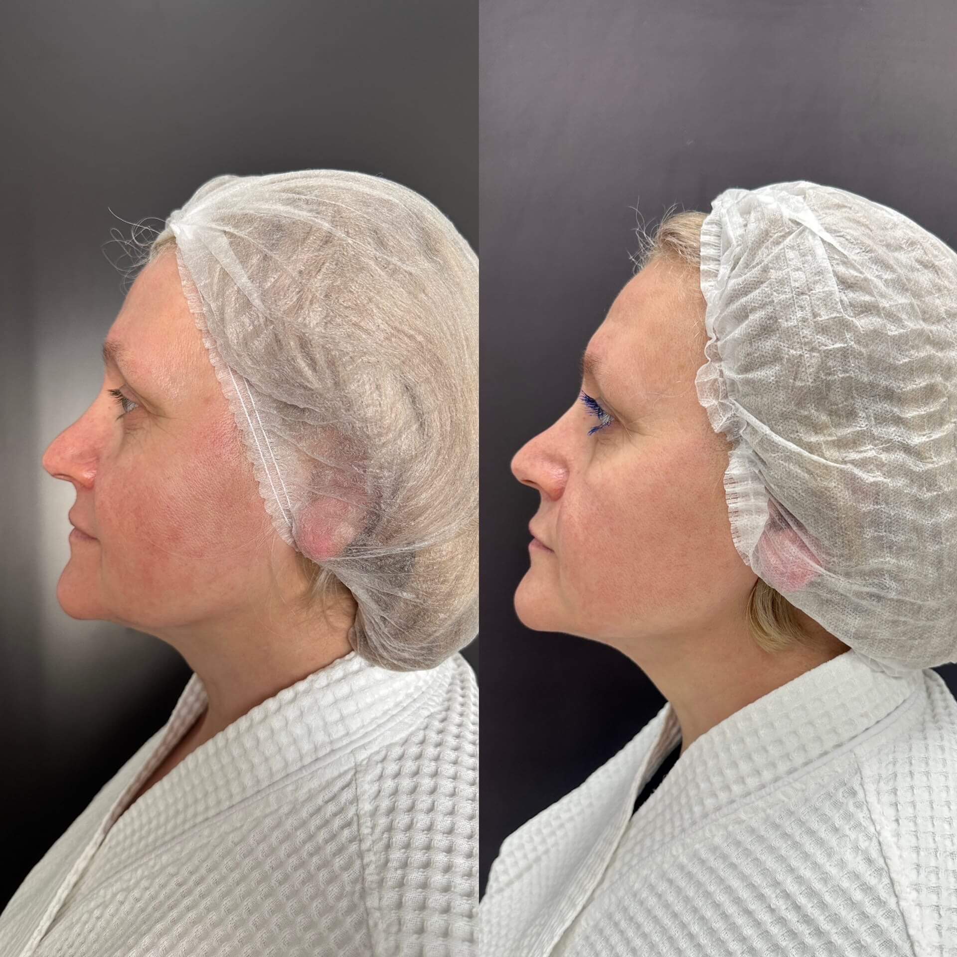 Микроигольчатый RF на аппарате Virtue RF 01