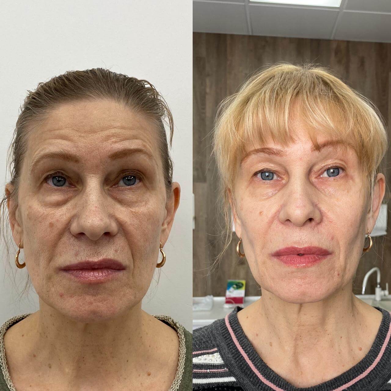 Коллагенотерапия Nithya 01