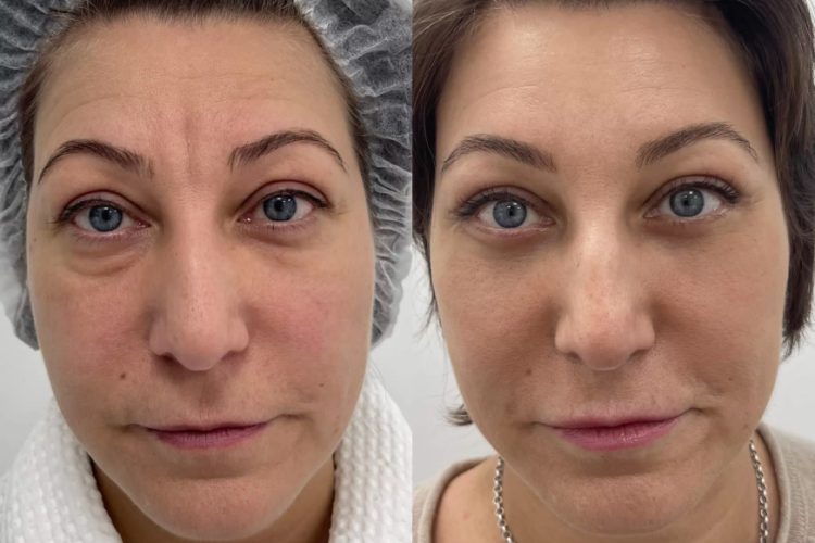 Эндоскопическая подтяжка лба и бровей: сколько стоит и как делается